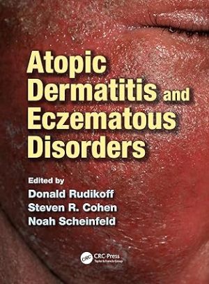 Atopic Dermatitis and Eczematous Disorders